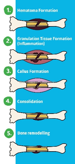5 stages bone fracture healing