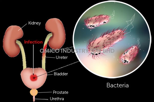 bladder infection